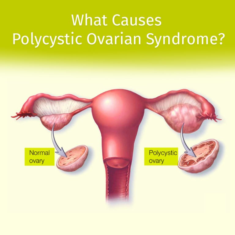 what-causes-pcos-dr-seema-sharma