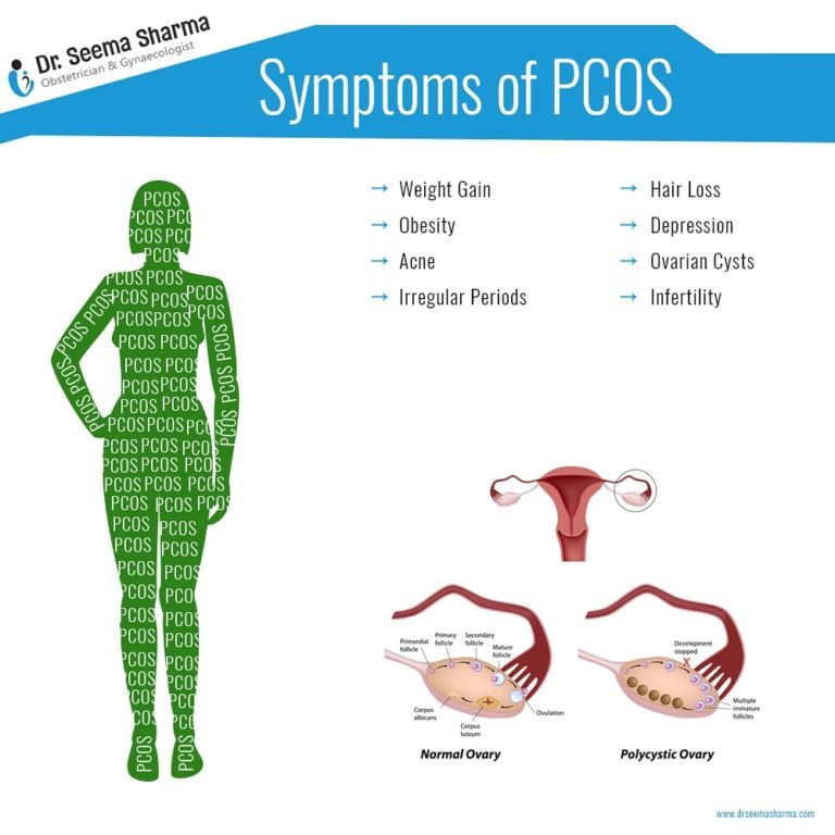 symptoms-of-pcos-dr-seema-sharma